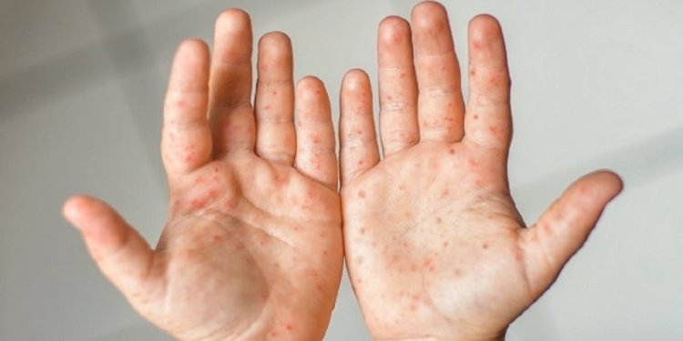 Ilustrasi pasien kasus positif cacar monyet (Mpox)/Net